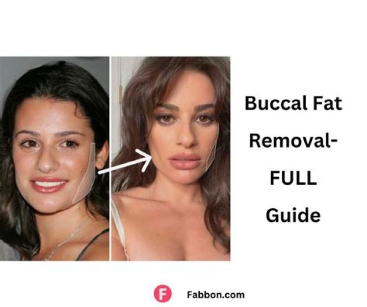 Celebrity Buccal Fat Removal: The Ultimate Guide to Achieving a Slimmer Face