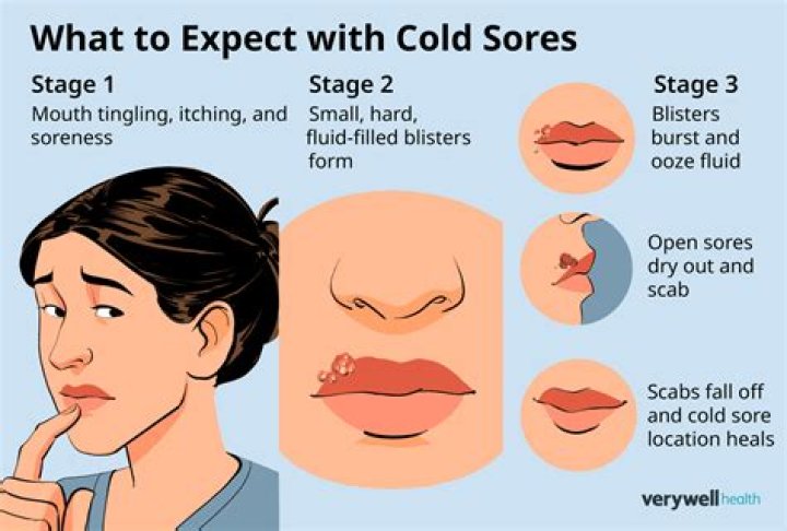 Cold Sores: Should I Pop the Blister? A Comprehensive Guide to Understanding and Managing Cold Sores
