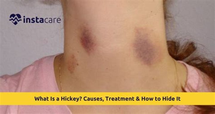 How to Cover a Hickey: The Ultimate Guide for Flawless Skin