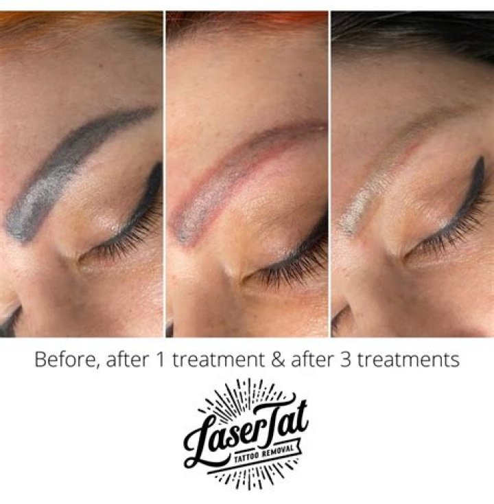 Laser Eyebrow Tattoo Removal Cost: A Comprehensive Guide to Understanding the Procedure