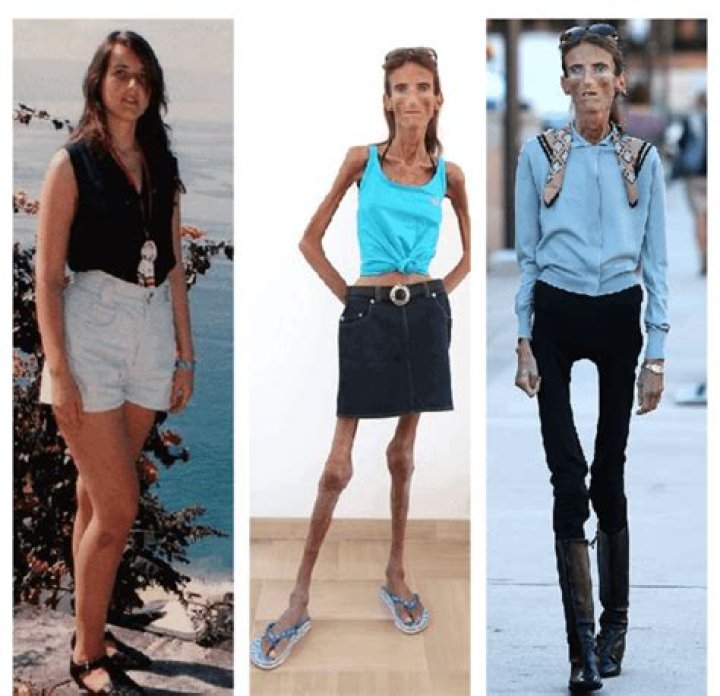 The Identity of the Skinniest Person in the World: A Comprehensive Exploration