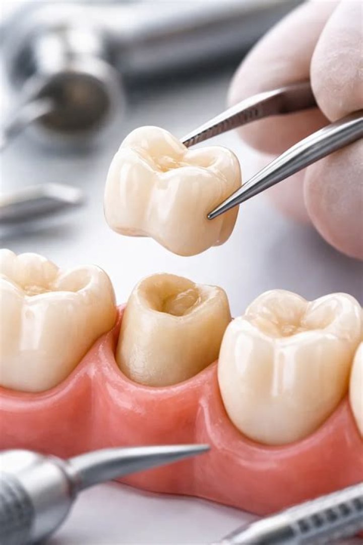 Tooth Crown Surgery: Everything You Need to Know for a Healthy Smile
