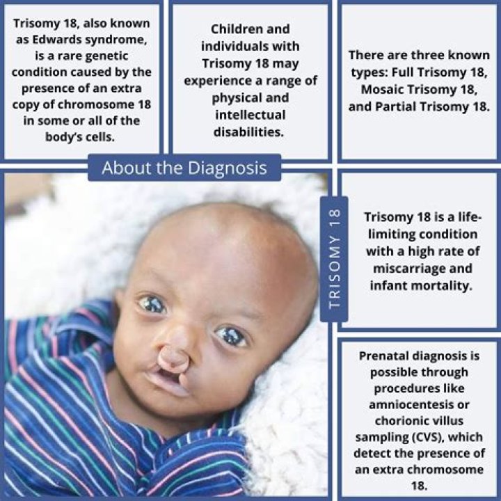 Understanding Trisomy 16 Life Expectancy: Insights, Challenges, and Hope