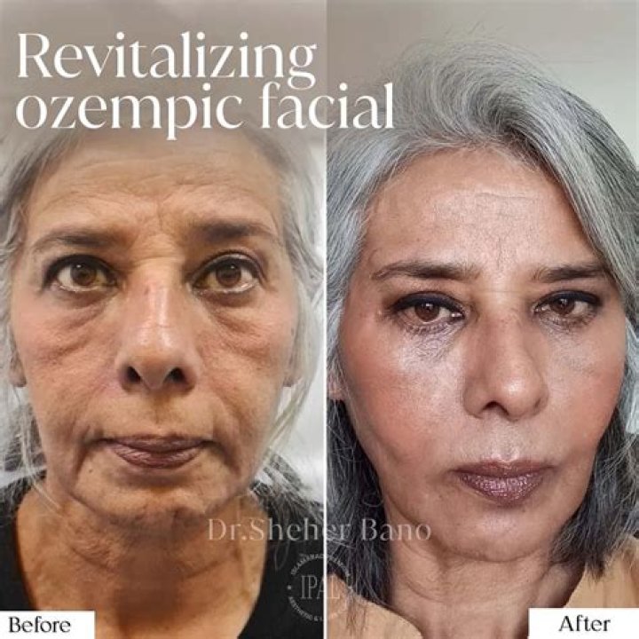 What is Ozempic Face Before and After: A Comprehensive Guide